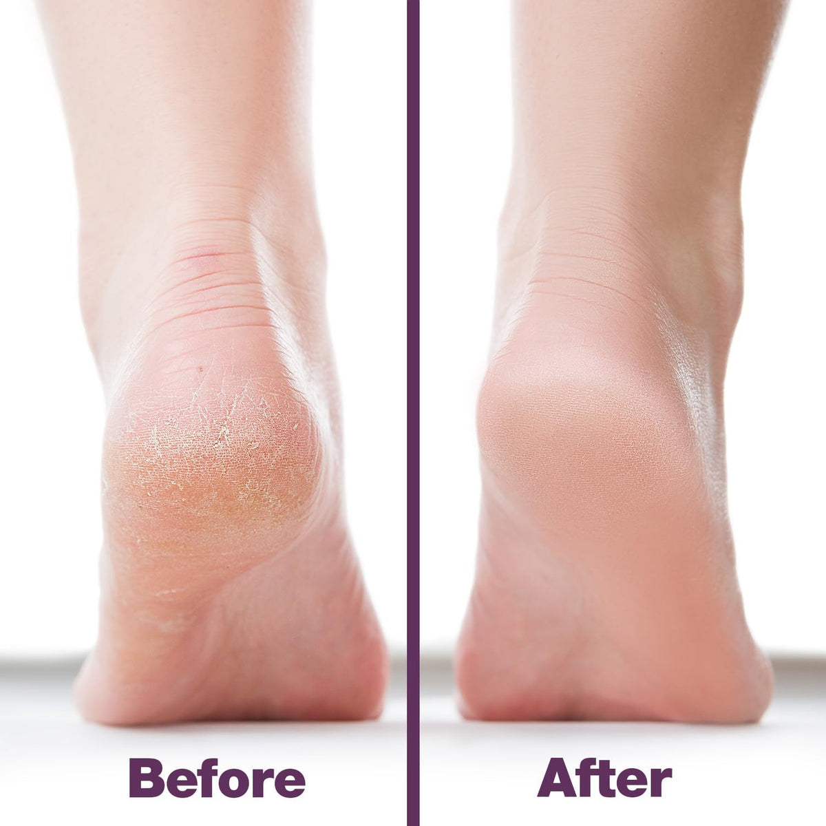Probelle Double Sided Multidirectional Nickel Foot File Callus Remover - Immediately Reduces